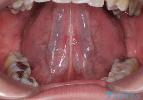 舌小帯が気になる。 舌小帯切除術の治療後