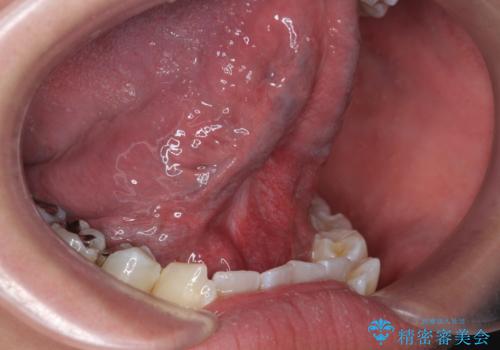 舌小帯が気になる。 舌小帯切除術の症例 治療後