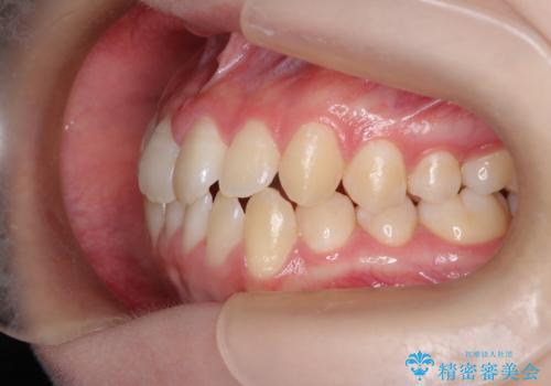 右上小臼歯の捻転を改善|インビザラインと部分ワイヤー矯正のコンビネーション治療の治療前