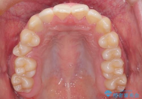 右上小臼歯の捻転を改善|インビザラインと部分ワイヤー矯正のコンビネーション治療の治療前