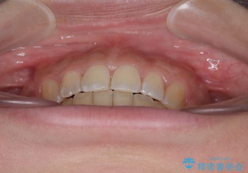 八重歯と上顎前突 ワイヤー装置での抜歯矯正の治療後
