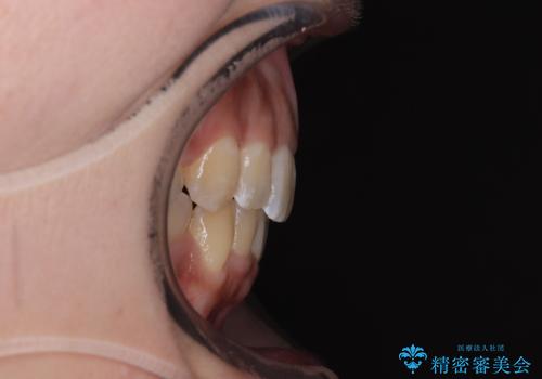 八重歯と上顎前突 ワイヤー装置での抜歯矯正の治療後