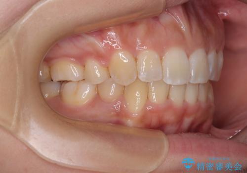 八重歯と上顎前突 ワイヤー装置での抜歯矯正の治療後