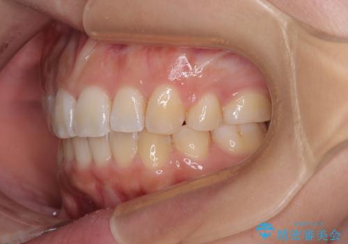 八重歯と上顎前突 ワイヤー装置での抜歯矯正の治療後