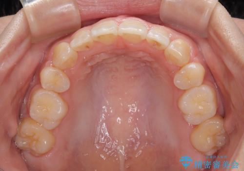 八重歯と上顎前突 ワイヤー装置での抜歯矯正の治療後