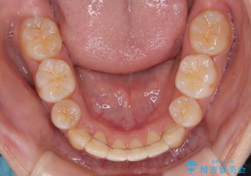 八重歯と上顎前突 ワイヤー装置での抜歯矯正の治療後