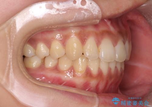 前歯のがたつきをすっきり マウスピース矯正の治療後