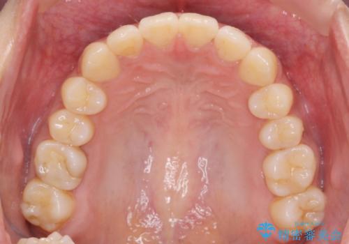 前歯のがたつきをすっきり マウスピース矯正の治療後
