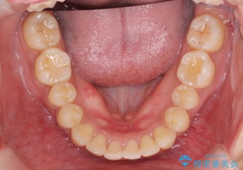 前歯のがたつきをすっきり マウスピース矯正の治療後