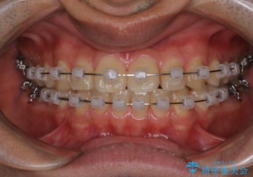 【クリア装置】前歯のがたつきが気になるの治療中