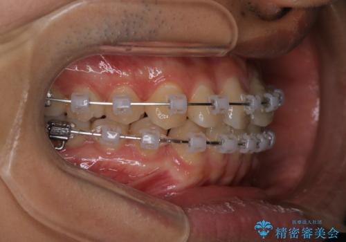 【クリア装置】前歯のがたつきが気になるの治療中