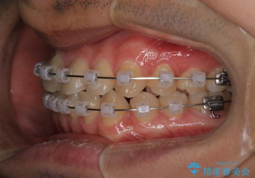 【クリア装置】前歯のがたつきが気になるの治療中
