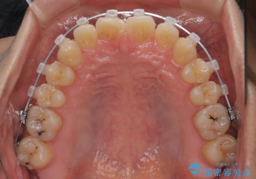 【クリア装置】前歯のがたつきが気になるの治療中