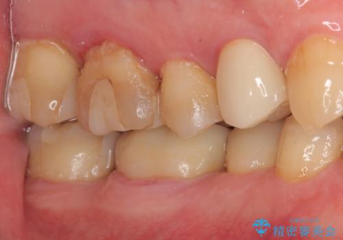 歯が欠けてしまった。オールセラミッククラウンによる補綴治療の治療後