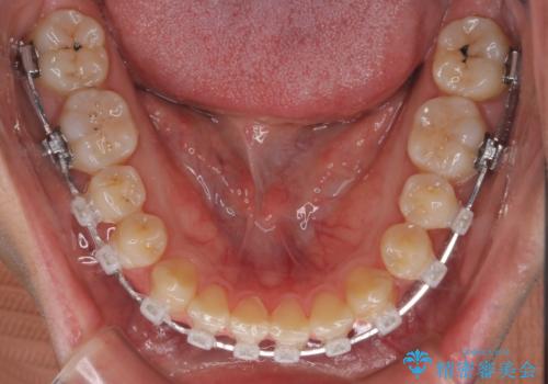 【クリア装置】前歯のがたつきが気になるの治療中