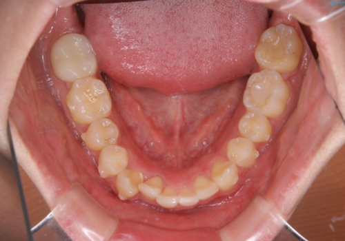 低予算・短期間での歯並び改善:インビザライン治療の治療中