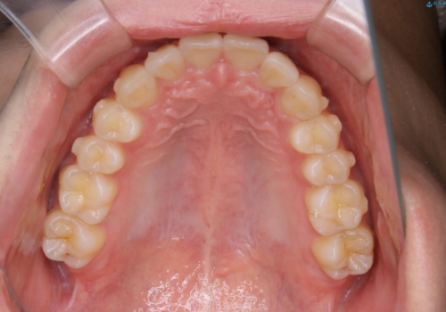低予算・短期間での歯並び改善:インビザライン治療の治療中