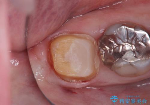 【オールセラミッククラウン】銀歯の下が虫歯に!の治療中
