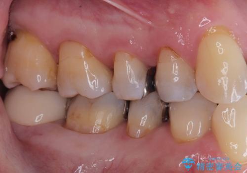 【オールセラミッククラウン】銀歯の下が虫歯に!の治療後