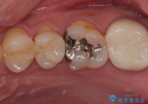 物が詰まる オールセラミッククラウンの治療前