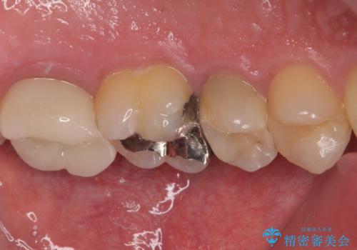 物が詰まる オールセラミッククラウンの治療前