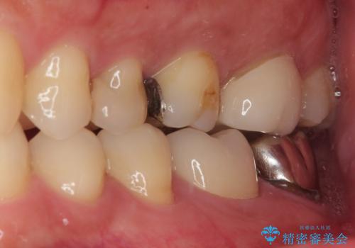 物が詰まる オールセラミッククラウンの治療前