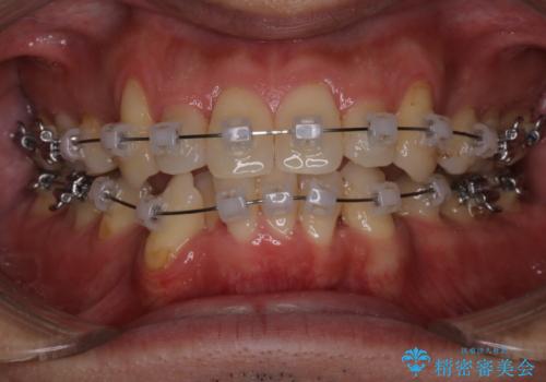 【クリア装置】がたつきを治したいの治療中