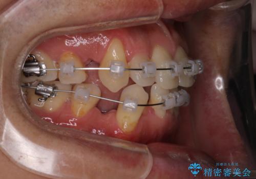 【クリア装置】がたつきを治したいの治療中