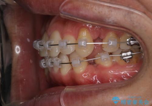 【クリア装置】がたつきを治したいの治療中