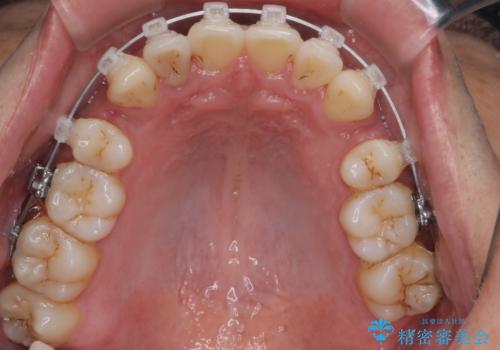 【クリア装置】がたつきを治したいの治療中