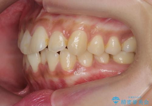 前歯のがたつきをすっきり マウスピース矯正の治療前