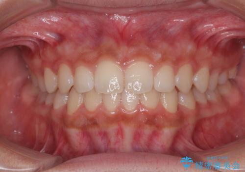 気になるすきっ歯を短期間で改善 インビザライン矯正の治療中