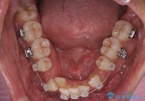 【クリア装置】がたつきを治したいの治療中