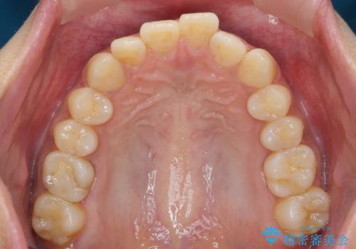 前歯のがたつきをすっきり マウスピース矯正の治療前