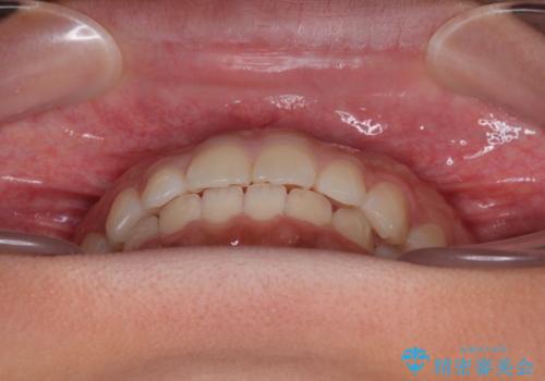 気になるすきっ歯を短期間で改善 インビザライン矯正の治療中