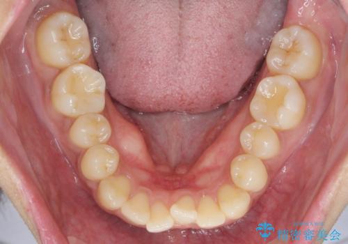 前歯のがたつきをすっきり マウスピース矯正の治療前