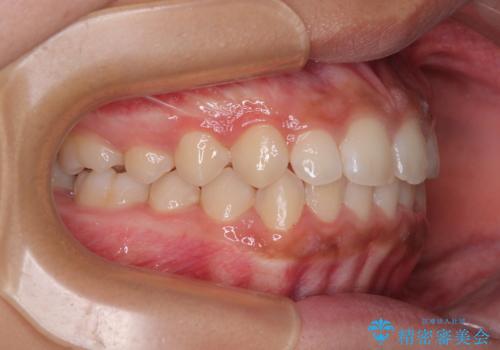 気になるすきっ歯を短期間で改善 インビザライン矯正の治療中