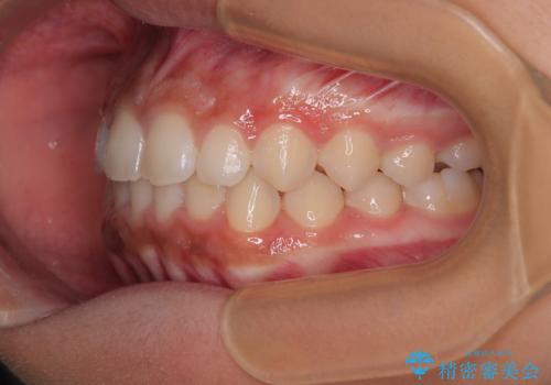 気になるすきっ歯を短期間で改善 インビザライン矯正の治療中