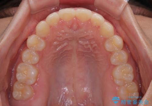 気になるすきっ歯を短期間で改善　インビザライン矯正の治療中