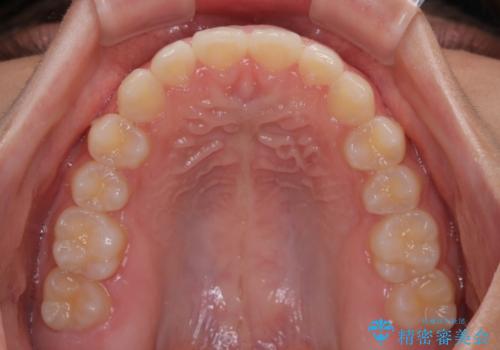気になるすきっ歯を短期間で改善 インビザライン矯正の治療中