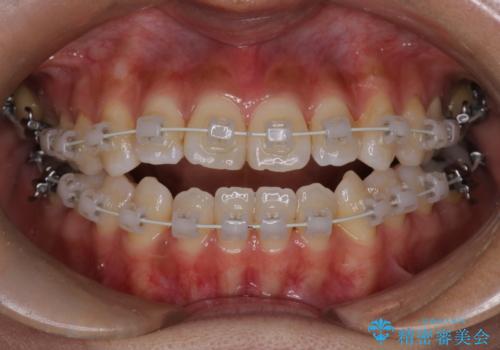 【モニター】開咬(オープンバイト)を治したい ワイヤー装置の治療中