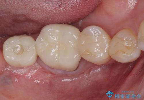 放置した奥歯 部分矯正を併用したインプラント補綴治療の治療後