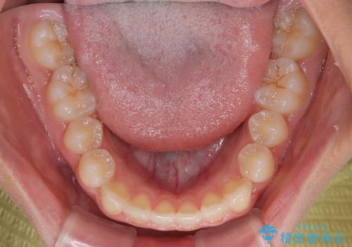 気になるすきっ歯を短期間で改善 インビザライン矯正の治療中