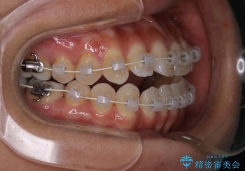 【モニター】開咬(オープンバイト)を治したい ワイヤー装置の治療中