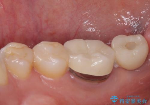 放置した奥歯 部分矯正を併用したインプラント補綴治療の治療後
