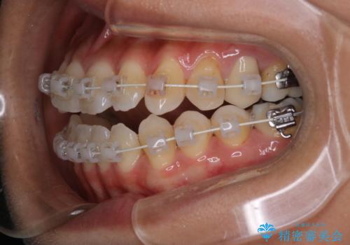 【モニター】開咬(オープンバイト)を治したい ワイヤー装置の治療中