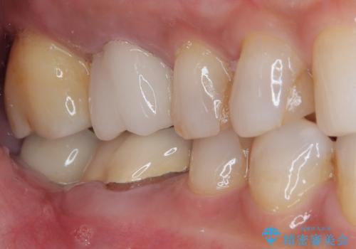 放置した奥歯 部分矯正を併用したインプラント補綴治療の治療後