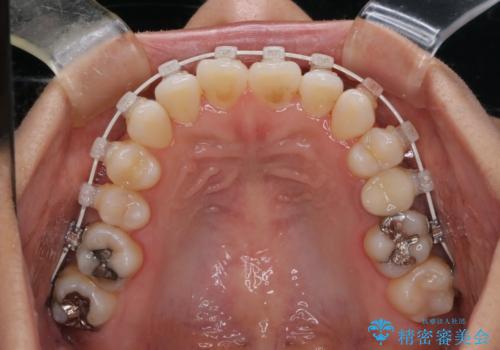 【モニター】開咬(オープンバイト)を治したい ワイヤー装置の治療中