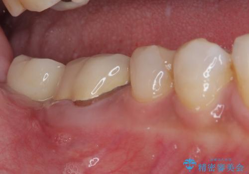 放置した奥歯 部分矯正を併用したインプラント補綴治療の治療後