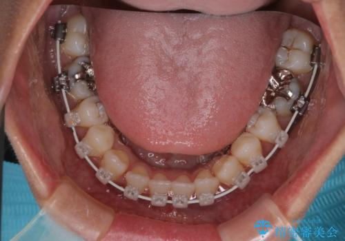 【モニター】開咬(オープンバイト)を治したい ワイヤー装置の治療中